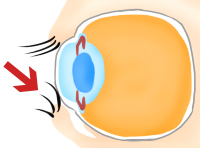 眼瞼内反症の画像
